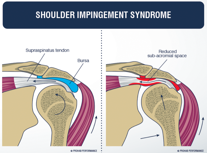 Shoulder Impingement - BTST Osteopathy, Edwinstowe